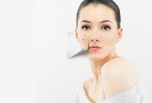 Cara Menutupi Bekas Jerawat Dalam 17 Hari