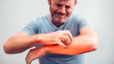 5 Ciri-ciri Gatal lantaran Diabetes, Jangan Asal Garuk