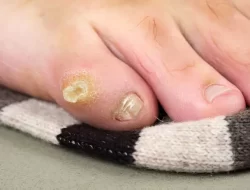 Penyebab Mata Ikan serta Cara Menghilangkannya, Jangan Asal Diobati