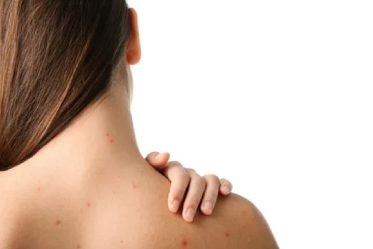 Tips Ampuh Menghilangkan Jerawat di tempat area Punggung, Harus Konsisten!